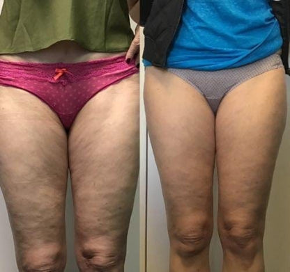 NooraWell™ - Anti-cellulite Massage Oil